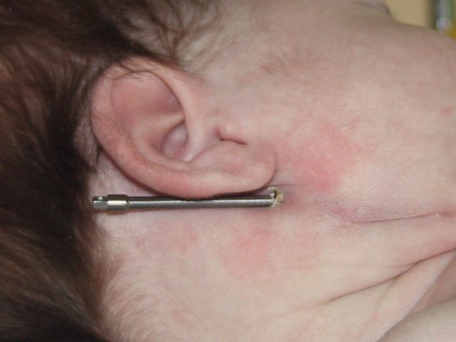 Недоразвитие нижней челюсти у ребенка: лечение аномалии у специалистов и дома