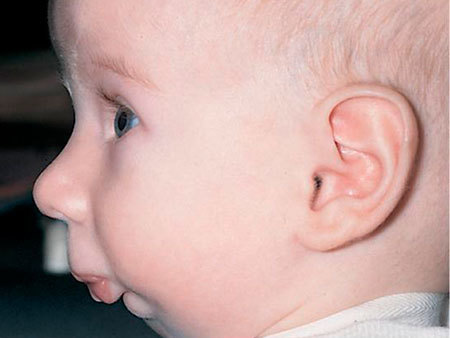 Недоразвитие нижней челюсти у ребенка: лечение аномалии у специалистов и дома